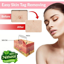 Load image into Gallery viewer, Skin Tag and Acne Remover Patches 72 Pcs
